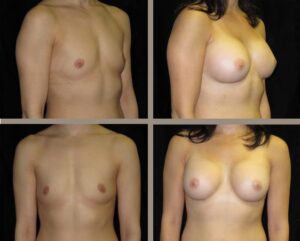 are you considering cosmetic breast surgery 5ccc9f2ad86b5