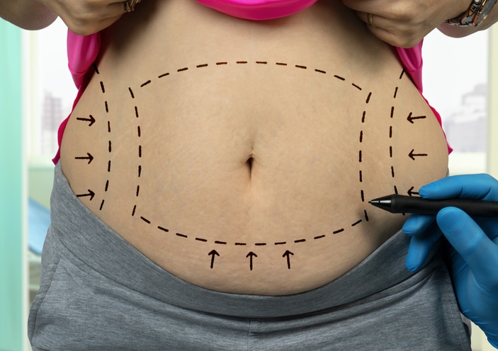 female stomach with marking for tummy tuck surgery 