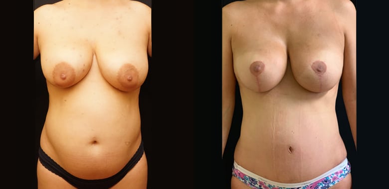 14546 imageset 1 before after 14546 imageset 1 before after