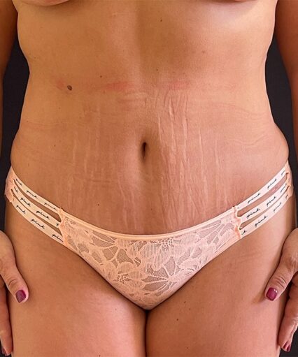 Liposuction Back and Flanks Treatment Gallery in New Bern, NC