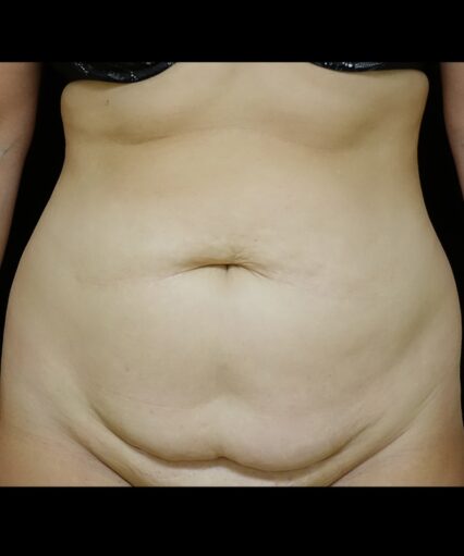 Liposuction Back and Flanks Treatment Gallery in New Bern, NC